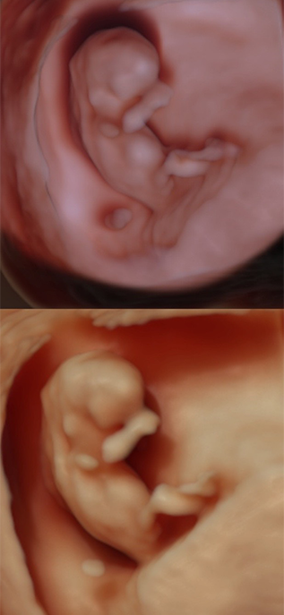 First Trimester ultrasound